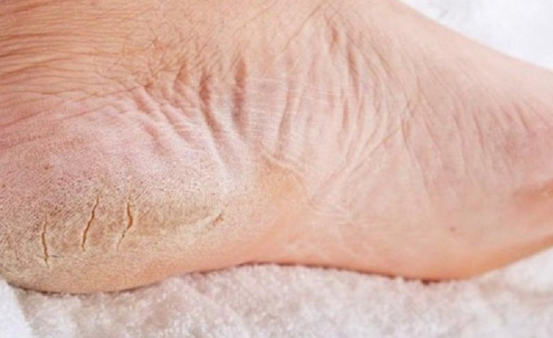 Ороговевшая кожа ног? это средство лучше пемзы и даже электрической пилки!