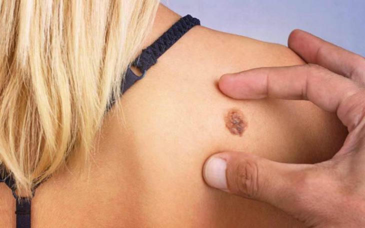 4 неизвестных ранее причины, повышающих риск меланомы (рака кожи)