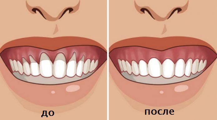 Вы заметили оголение шейки или корня зуба? Немедленно начинайте лечение — 6 натуральных рецептов…