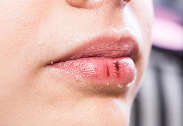 Поврежденные губы — причины, домашние средства, меры предосторожности